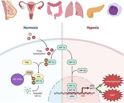 WT1: The Hinge Between Anemia Correction and Cancer Development in Chronic Kidney Disease